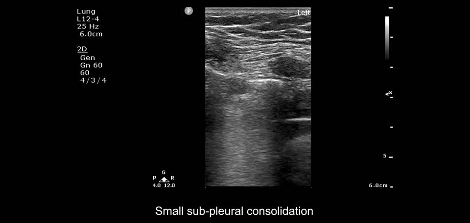 small sub-pleural consolidation