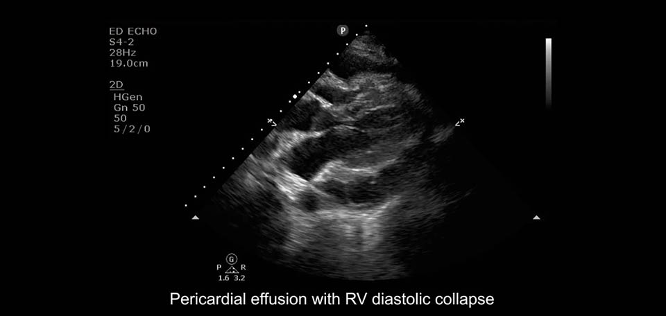 pericardial effusion with rv diastolic collapse