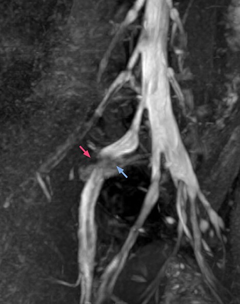 MRI of right L5 radiculopathy