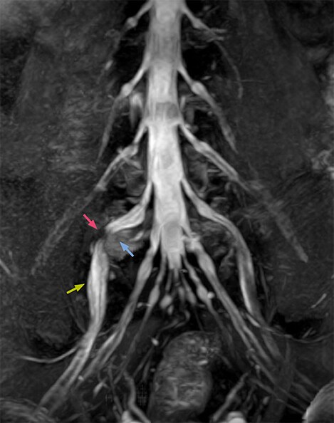 MRI of right L5 radiculopathy