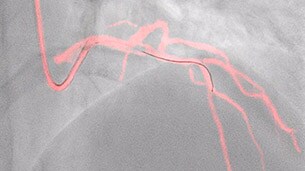 dynamic coronary roadmap thumbnail