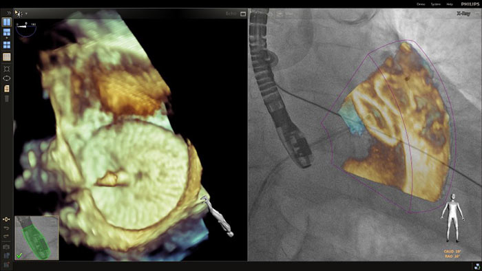 3D Zoom overlay in a LAA closure procedure