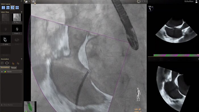 EchoNav models aorta mitral