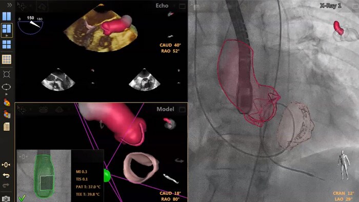Transeptal puncture guidance