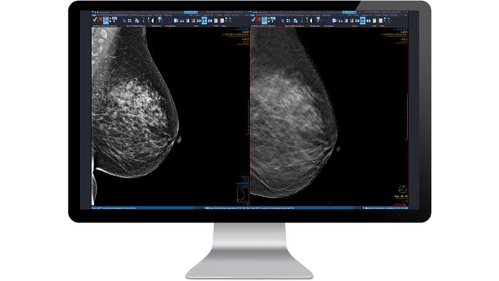 Acquisition mammographie sur l’écran de l’ordinateur