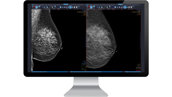 Mammography scan on computer screen